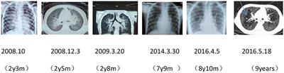 Familial Interstitial Lung Disease Caused by Mutation of the STING1 Gene